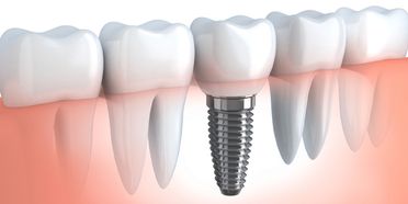 Clínica Dental Binai prótesis dental